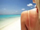 amazing-natural-remedies-for-sunburns